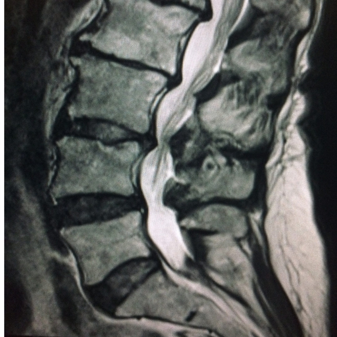 MRI of lumbar spine sagital view, T2 weighted image with mod to severe  arthritis and disc herniation causing spinal stenosis