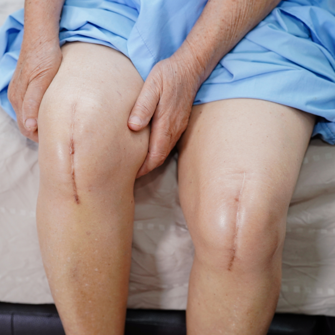 woman sitting on the edge of bed, holding her right knee post total knee operation