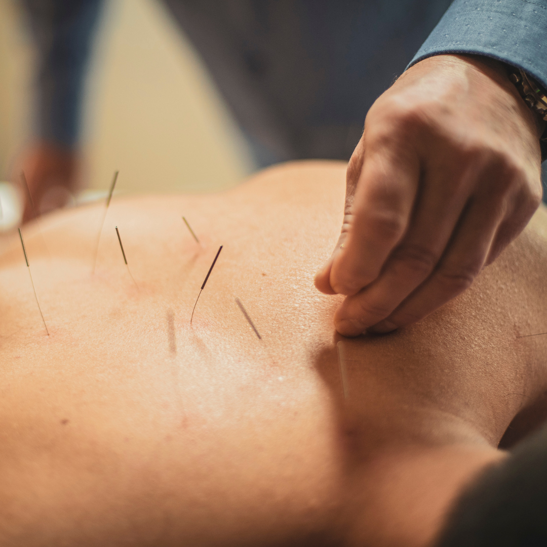 traditional acupuncture being performed on a patient while they are laying prone, on their stomach