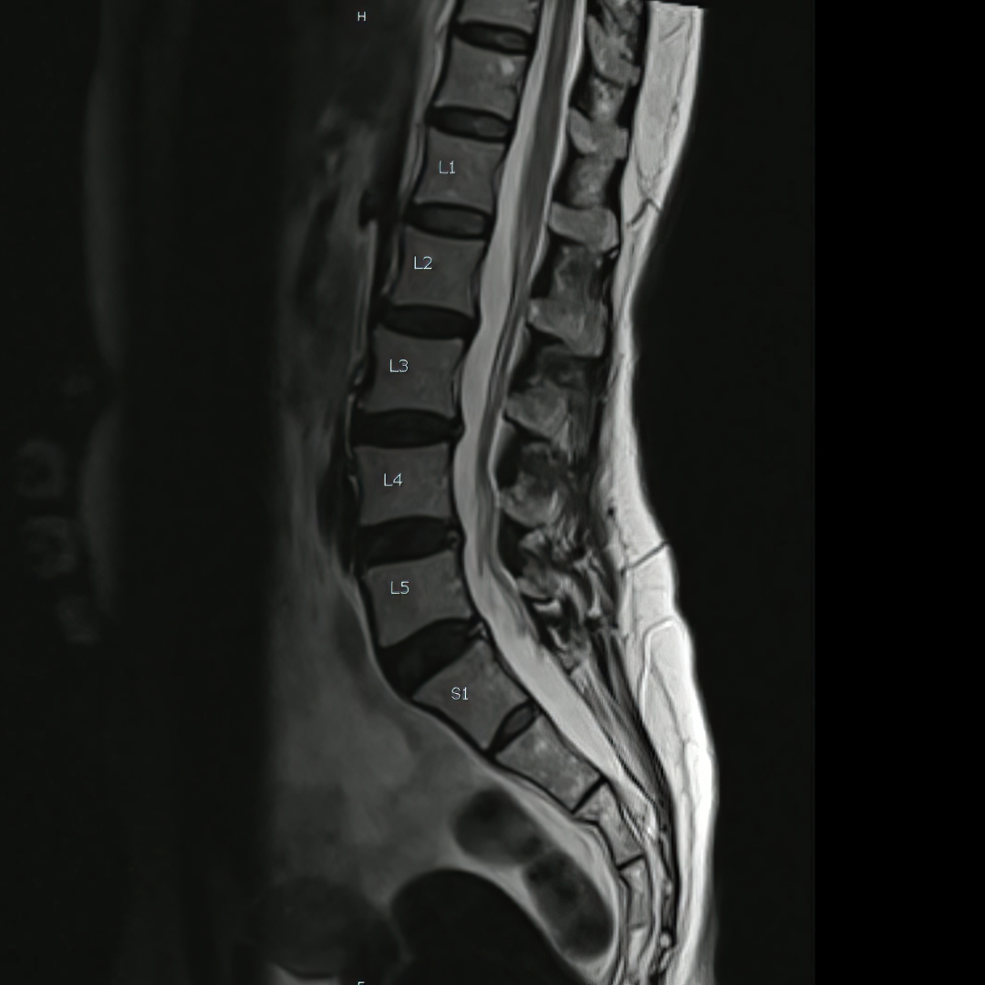 MRI of a lumbar spine sagital view with disc bulges but no spinal stenosis