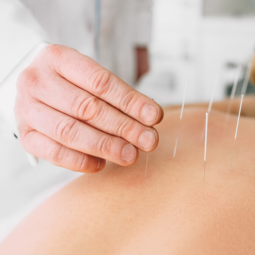 a patient having acupuncture treatment performed