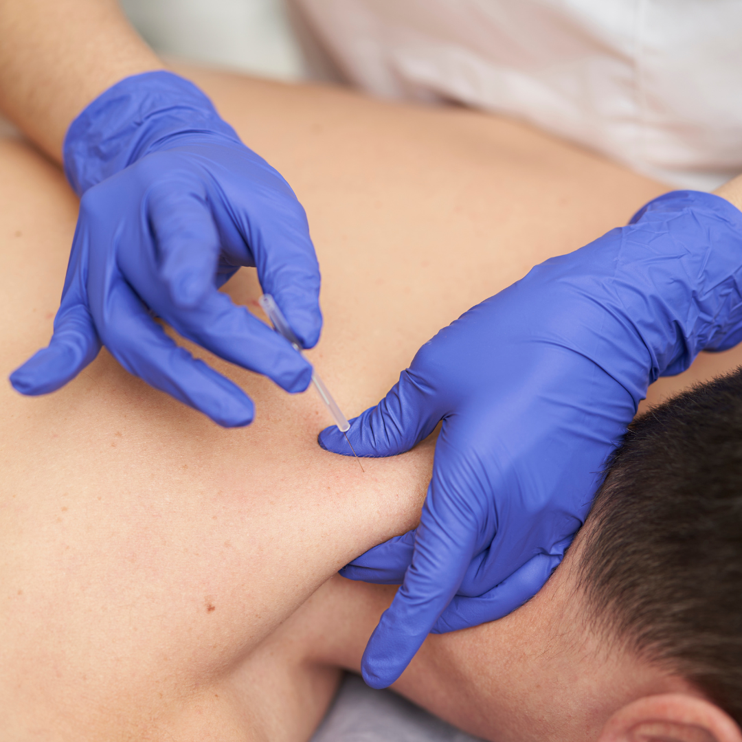 A patient having intramuscular stimulation (IMS) treatment performed, while laying on their stomach