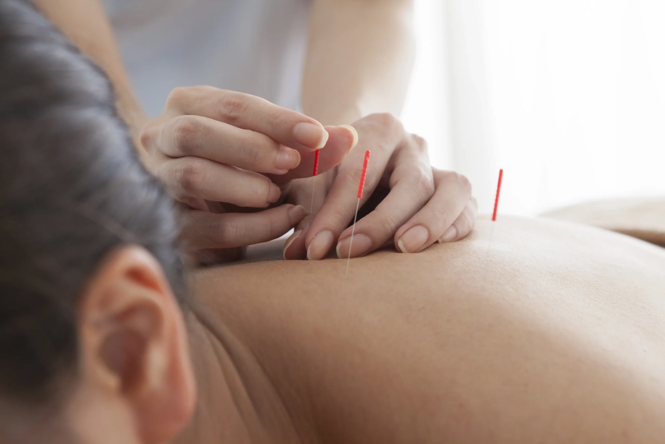 chiropractor performing acupuncture on a patient