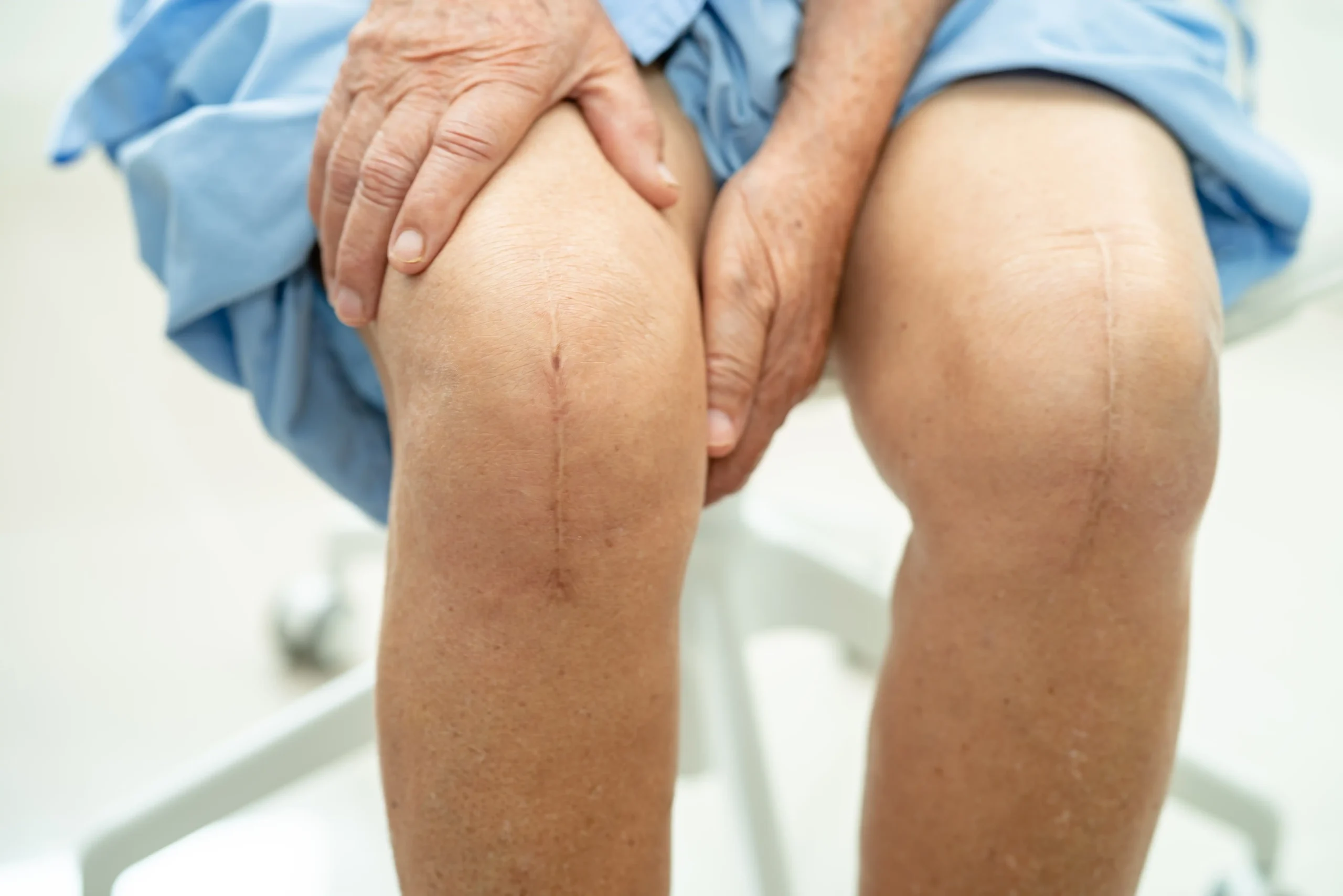 Women with Post surgical knee pain